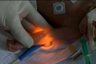 Newborn Veins