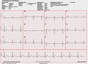 PC ECG Sample